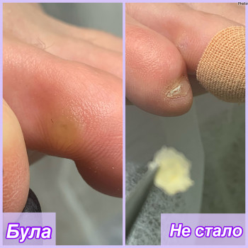 мозоль на пальце ноги