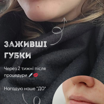 Alexa Medium 0,5ml (заживші губки через 2 тижні після процедури)