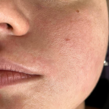 Шугаринг / Депіляція
                    Майстер депіляції Наталья Одеса