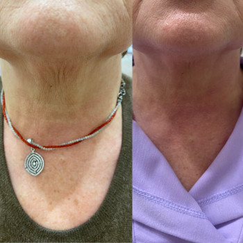 Revanelle Tone, результат після першої процедури