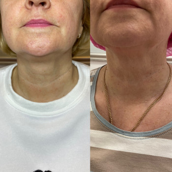 Мезотерапія для ущільнення шкіри
                    Косметолог Людмила Київ