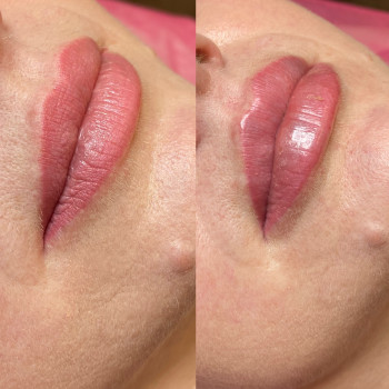 Контурна пластика губ
                    Косметолог Людмила Киев