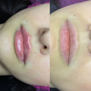 Контурна пластика губ
                    Косметолог Людмила Киев