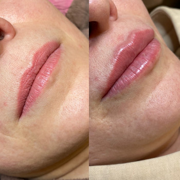 Контурна пластика губ
                    Косметолог Людмила Киев