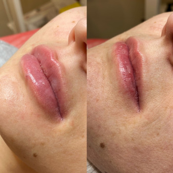 Контурна пластика губ
                    Косметолог Людмила Киев