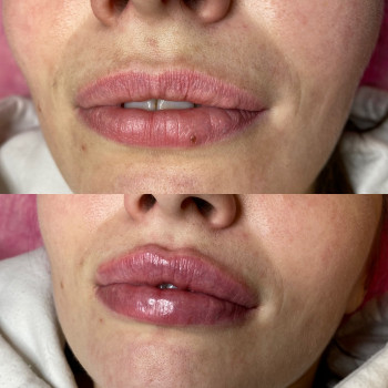 Контурна пластика губ
                    Косметолог Людмила Киев