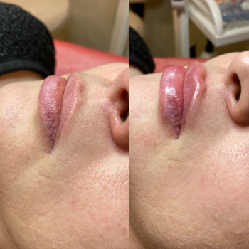 Контурна пластика губ
                    Косметолог Людмила Киев