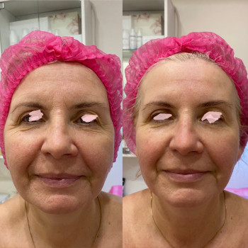 Міофасціальний масаж обличчя
                    Косметолог Людмила Київ