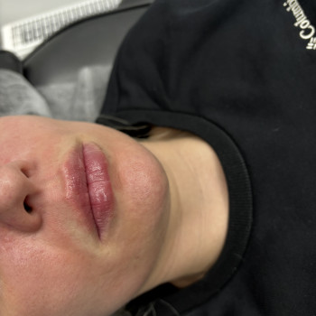 Збільшення губ
                    Стоматолог Ирина Луцк