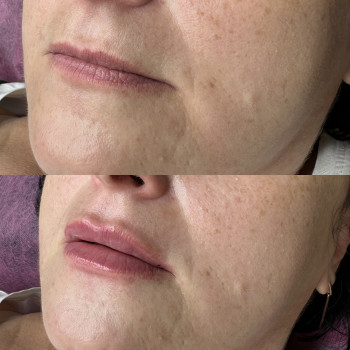 Збільшення губ 0,7мл.