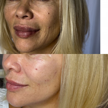 Комплекс процедур. Біоревіталізація (5 точок вколів), біоревіталізуючий пілінг, збільшення губ.