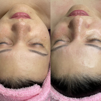 Комбінована чистка обличчя та пілінг.