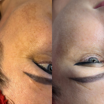 Біоревіталізація та пілінг.