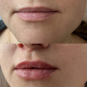 Збільшення губ ?1мл.