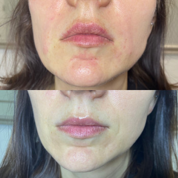 Заповнення носогубних заломів