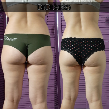 Липолитики
                    Косметолог Виктория Харків