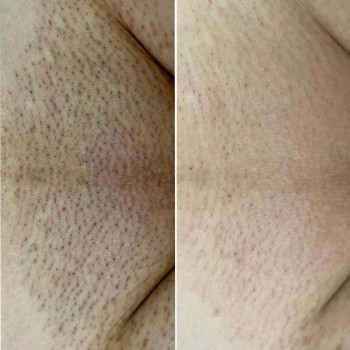 Результат 4 сеансів лазерної епіляції 

   