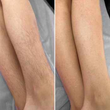 Депіляція гомілок воском
    