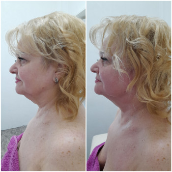 Результат однієї процедури