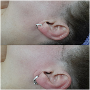 Результат однієї процедури скульптурного масажу обличчя