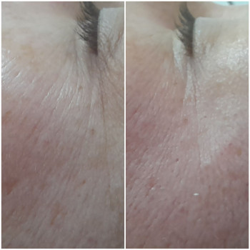 Результат однієї процедури скульптурного масажу обличчя