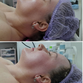 Результат однієї процедури скульптурного масажу обличчя