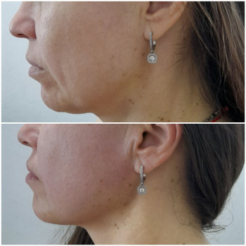 Результат однієї процедури скульптурного масажу обличчя