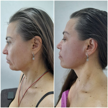 Результат однієї процедури скульптурного масажу обличчя