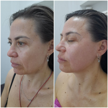 Результат однієї процедури скульптурного масажу обличчя