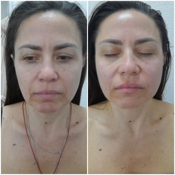 Результат однієї процедури скульптурного масажу обличчя