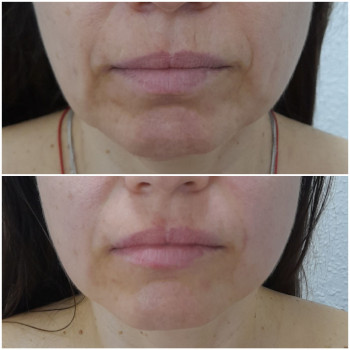 Результат однієї процедури скульптурного масажу обличчя