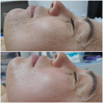 Результат однієї процедури скульптурного масажу обличчя