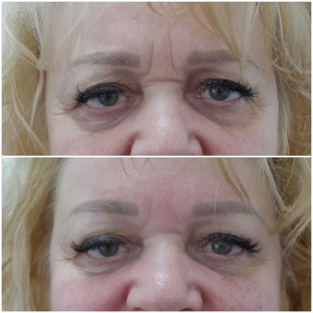 Результат однієї процедури скульптурного масажу обличчя