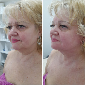 Результат однієї процедури скульптурного масажу обличчя