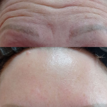 Ботоксльвів     