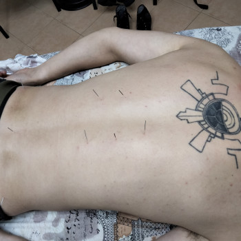  #Голковколювання