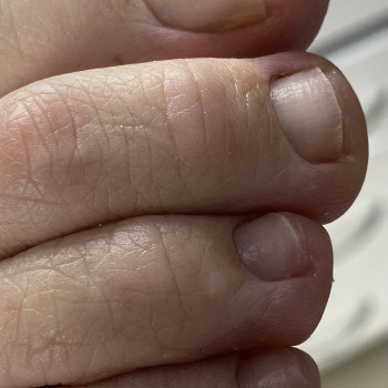 Апаратний медичний педикюр
                    Подолог Марина Одеса