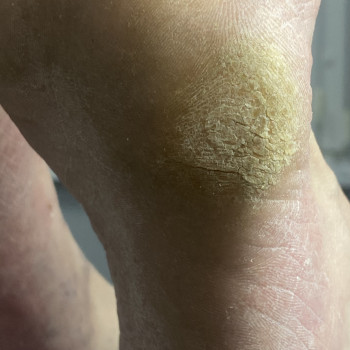 Апаратний медичний педикюр
                    Подолог Марина Одеса