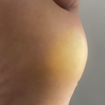 Апаратний медичний педикюр
                    Подолог Марина Одеса