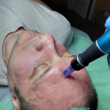 Фракционная микроигольчатая мезотерапия
                    Косметолог-эстетист Марина Одесса