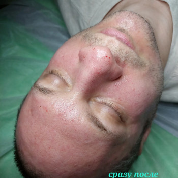 Фракционная микроигольчатая мезотерапия
                    Косметолог-эстетист Марина Одесса