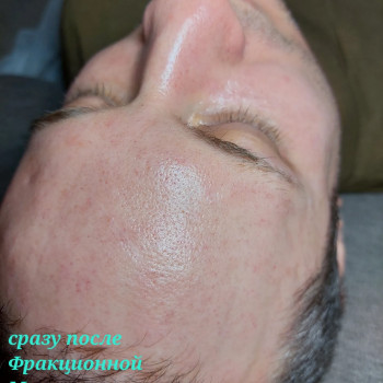 Фракционная микроигольчатая мезотерапия
                    Косметолог-эстетист Марина Одесса