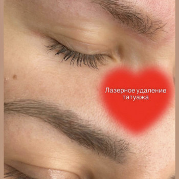 Лазерное удаление бровей
                    Майстер перманентного макіяжу Ирина Полтава