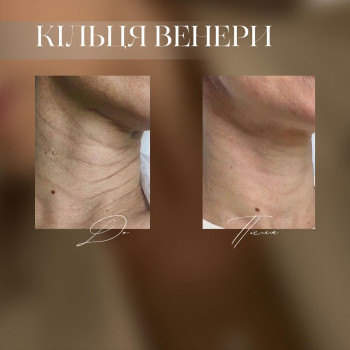 корекціяз моршок, кільця венери