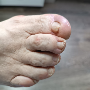 До процедури