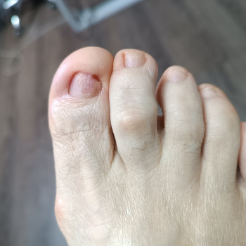 Після процедури