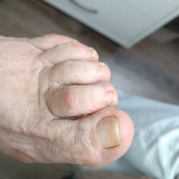 До процедури