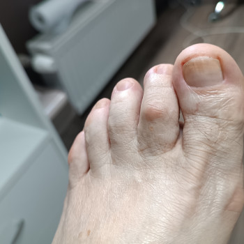 Після процедури