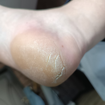 Медичний педикюр
                    Подолог  Кременчуг