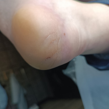 Медичний педикюр
                    Подолог  Кременчуг